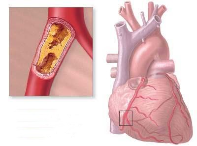 Heart Disease