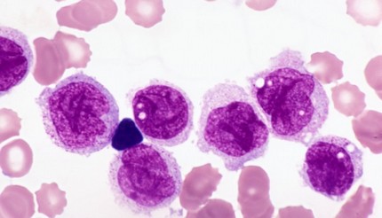 Leukemia